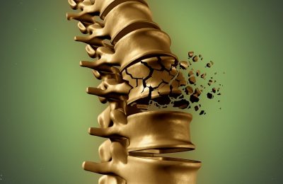 Более 1 200 новосибирцев страдают остеопорозом