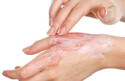 Ожоги: инструкция по спасению без ошибок